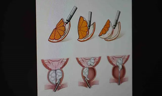 Erkeklerde sinsi tehlike çoğu zaman belirti vermiyor