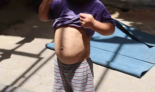 Gazze'de suçiçeği alarmı: Vakalar iki haftada 9 bini aştı